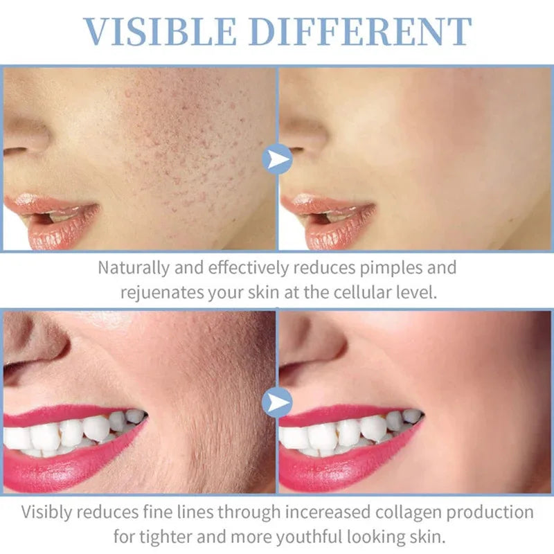 High Frequency Skin Therapy Wand Machine Portable Handheld for Acne Massage Skin Rejuvenation Tightening Wrinkle Reducing Tool